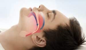 Upper Airway Resistance Syndrome